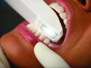 Scanning av tenner førbehandling.